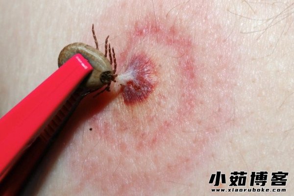 蜱虫叮咬人类皮肤后会在患处出现红色斑点,中间有一处瘀点或瘀斑,周围